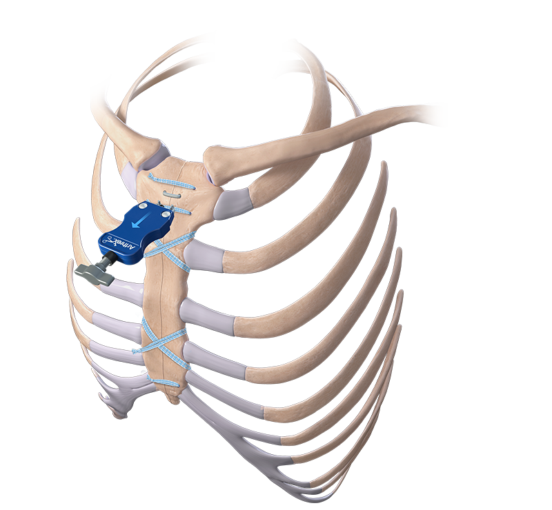 Arthrex - DynaNite® CT Nitinol Staples for Sternal Closure